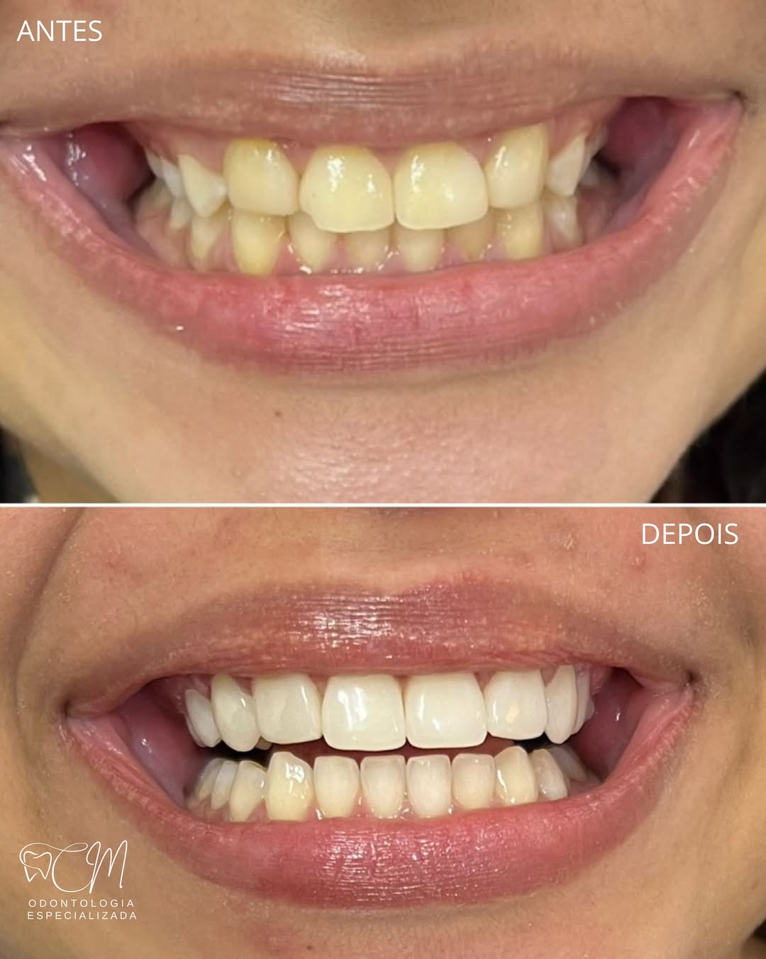 Lentes e Clareamento — antes e depois